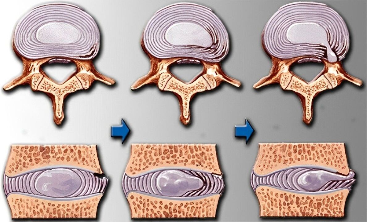 Osteokondroosi etapid